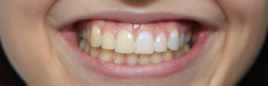 Zahnfarbe natürliche Zahnfarbe